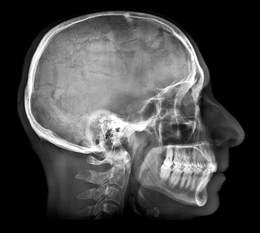 Calculating Pain and Suffering in a Brain Injury Case