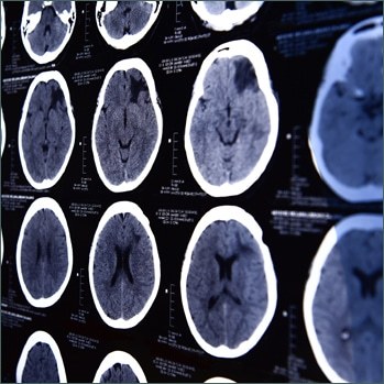 What Are the Leading Causes of Brain Injuries?